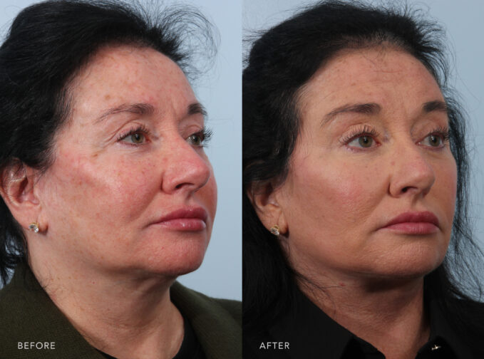 A side-by-side view of a woman's face before and after the Deep Plane Lower Face and Neck Lift procedure. Before photo shows loose and hanging skin along her jawline and lower cheeks, creating a saggy effect. The after photo shows visible cheekbones, giving her face a contoured and sculpted look. | Albany, Latham, Saratoga NY, Plastic Surgery