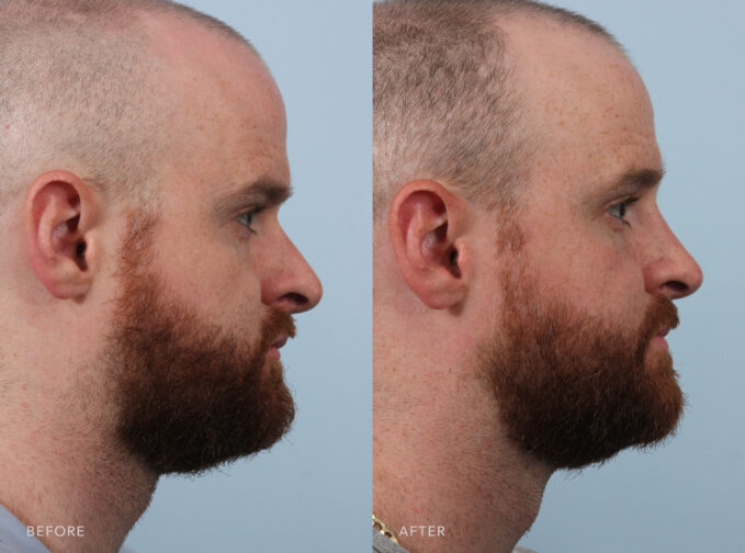 A side-by-side view of a man's face before and after the Endonasal Cosmetic Rhinoplasty procedure. Before photo shows an off-centered tip nose, pointing more towards one side than straight ahead. The after photo shows a smooth and even contoured nose without any irregularities or bumps along the bridge. | Albany, Latham, Saratoga NY, Plastic Surgery