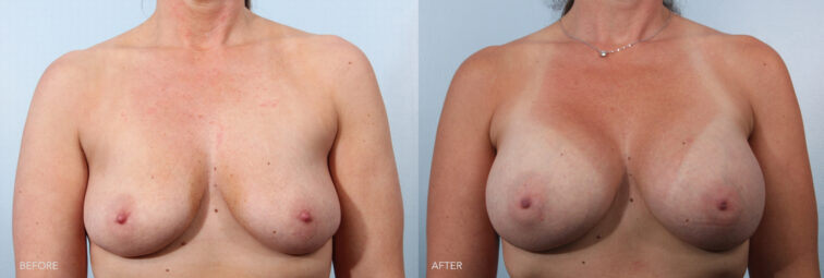 A photo of a woman's body before and after the Breast Augmentation with Implants procedure. Before photo shows a minimal amount of breast tissue, giving her a flat chest or nearly flat appearance. The after photo shows noticeable fullness, with a consistent volume distributed evenly throughout the breast tissue, extending from the upper to the lower part of her breast. | Albany, Latham, Saratoga NY, Plastic Surgery