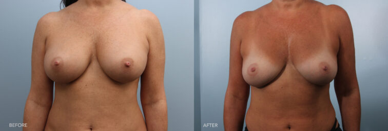 A photo of a woman's body before and after the Implant removal and Fat Grafting procedure. Before photo shows increased volume and fullness compared to its natural state, appearing larger and more pronounced, creating a more rounded and prominent chest profile. The after photo shows reduced volume and size compared to when the implants were in place. It returns closer to its natural size, though some changes in volume remain due to tissue stretching. | Albany, Latham, Saratoga NY, Plastic Surgery