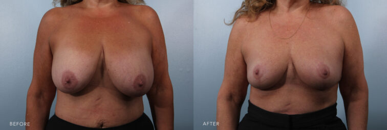 A photo of a woman's upper body before and after the Bilateral Breast Reduction procedure. Before photo shows large and heavy breasts, causing discomfort and aesthetic concerns and having the size of her breasts disproportionate to the rest of her body leading to an imbalance in overall body proportions. The after photo shows a smaller and more proportionate body frame, creating a balanced appearance that complements the rest of her body. | Albany, Latham, Saratoga NY, Plastic Surgery