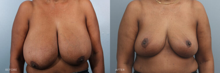 Photos of a woman's body before and after the Breast Reduction Procedure. Before photo shows discomfort caused by her saggy large breasts, while the after photo shows improved self-image with her removed excess fat in the breasts, which made her breast smaller.| Albany, Latham, Saratoga NY, Plastic Surgery