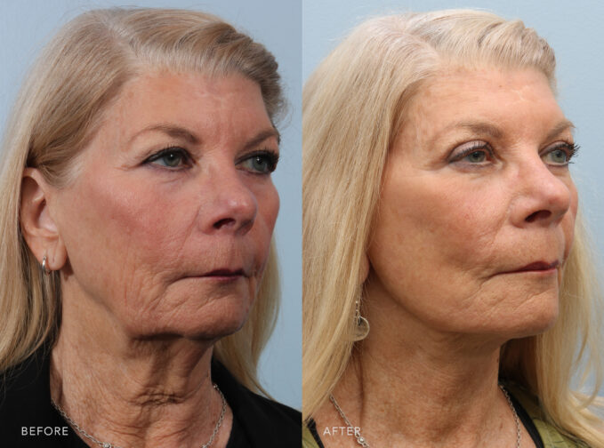 A side-by-side view of a woman's face before and after the Deep Plane Lower Face and Neck Lift procedure. Before photo shows a neck that has lost its elasticity and firmness, leading to a looser and more saggy appearance, contributing to the formation of wrinkles and folds. The after photo shows a jawline that appears more defined and sculpted, with a clear separation between the face and her neck, providing a sharper and more youthful profile. | Albany, Latham, Saratoga NY, Plastic Surgery