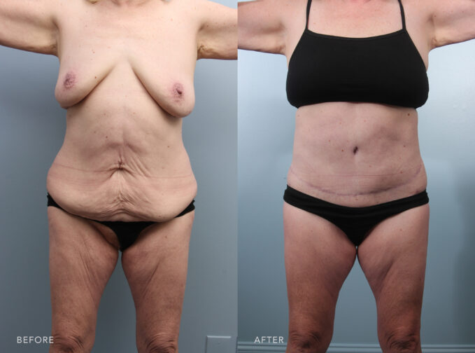 A photo of a woman's body before and after the Lower Body Lift procedure. Before photo shows a significant amount of loose, hanging skin in her lower abdomen, creating an apron-like effect. The after photo shows removed loose skin in her lower abdomen, leaving the area smoother and firmer without the overhanging folds that were present before. | Albany, Latham, Saratoga NY, Plastic Surgery