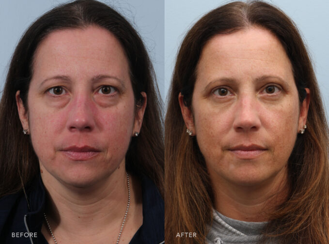 A photo of a woman's face shows puffy or swollen upper eyelids due to the accumulation of fat deposits, creating a heavy, tired appearance, even when well-rested. | Albany, Latham, Saratoga NY, Plastic Surgery