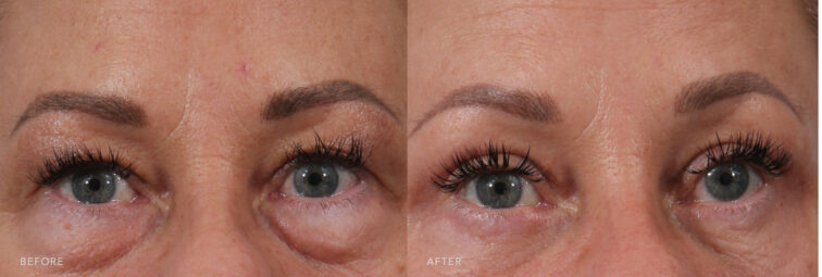 A photo of a woman's upper face before and after the Bilateral Upper and Lower Blepharoplasty procedure. Before photo shows a noticeable puffiness or bulging under her eyes, often more pronounced in the morning. The after photo shows removed excess skin and fat from the under-eye area, providing a more youthful appearance. | Albany, Latham, Saratoga NY, Plastic Surgery