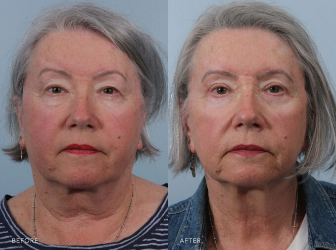 A photo of a woman's face before and after the Upper and Lower Blepharoplasty procedure. Before photo shows droopy or saggy upper eyelids with excess skin hanging over the natural eyelid crease, creating a tired or older appearance and obstructing her peripheral vision. The after photo shows smooth and well-defined upper eyelids with excess skin removed, giving the eyes a more open and alert look. | Albany, Latham, Saratoga NY, Plastic Surgery