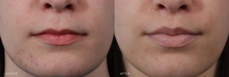 A photo of a woman's face before and after the Lip Lift procedure. Before photo shows a noticeable imbalance between her upper and lower lips, with the lower lip significantly fuller than the upper lip. The after photo shows a harmonious balance between her upper and lower lips, enhancing her overall facial symmetry. | Albany, Latham, Saratoga NY, Plastic Surgery