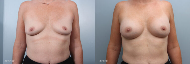 A photo of a woman's body before and after the Breast Augmentation Procedure. Before photo shows smaller or less developed breasts than desired, making it disproportionate to the rest of her body. The after photo shows a noticeable change in her breast size and volume, particularly in the upper poles, giving a more youthful and lifted look. | Albany, Latham, Saratoga NY, Plastic Surgery