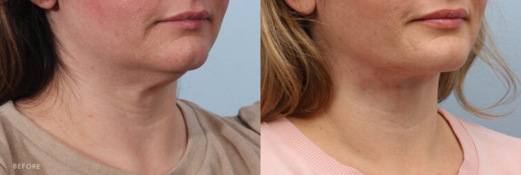 A side-by-side view of a woman's lower face before and after the Deep Plane Lower Face and Neck Lift procedure. Before photo shows folds that run from the sides of the nose to the corners of her mouth becoming deeper and more pronounced, contributing to an aged or tired look. The after photo shows reduced lines from the nose to her mouth and vertical lines from the mouth to her chin, contributing to a smoother and more youthful appearance. | Albany, Latham, Saratoga NY, Plastic Surgery