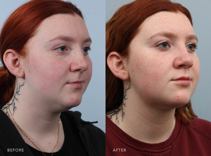 A side-by-side view of a woman's face before and after the Neck Liposuction procedure. Before photo shows lines and contours of her neck are soft and less defined with the absence of a clear delineation between the jawline and her neck. The after photo shows reduced fullness in her neck, resulting in a thinner and more streamlined neck with removed excess fat deposits, leading to a leaner profile. | Albany, Latham, Saratoga NY, Plastic Surgery