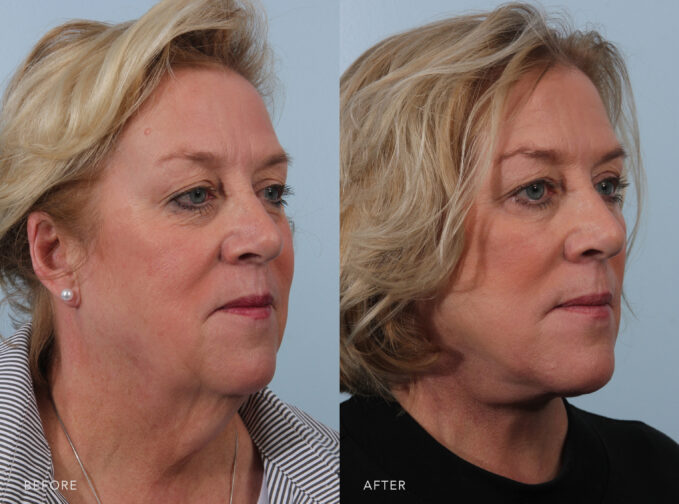 A side-by-side view of a woman's face before and after the Deep Plane Lower Face and Neck Lift procedure. Before photo shows a skin that sags downward, contributing to the formation of jowls along her jawline. The after photo shows more elastic and resilient skin, bouncing back with facial movements rather than staying loose or drooping. | Albany, Latham, Saratoga NY, Plastic Surgery