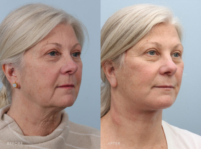 A side-by-side view of a woman's face before and after the Deep Plane Lower Face and Neck Lift procedure. Before photo shows a skin that loses its firmness, causing her to develop jowls, which are sagging or drooping along her jawline, creating a heavy or slack appearance. The after photo shows diminished or eliminated jowls along her jawline, resulting in a firmer and more defined jawline, giving her face a cleaner and more youthful contour. | Albany, Latham, Saratoga NY, Plastic Surgery