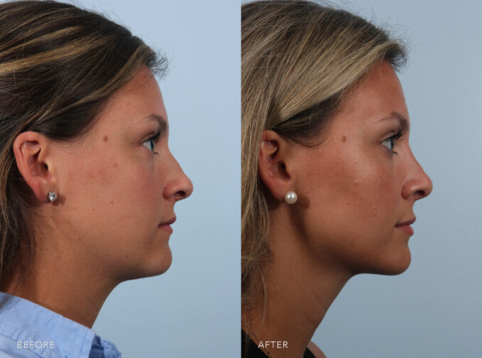 A side-by-side view of a woman's face before and after the Cosmetic Rhinoplasty procedure. Before photo shows a round nasal tip rather than a defined and refined one, affecting both the appearance and breathing functionality. The after photo shows a more defined and less bulbous nasal tip, creating a balanced and harmonious tip that suits her face. | Albany, Latham, Saratoga NY, Plastic Surgery