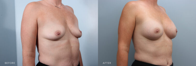 A side-by-side view of a woman's body before and after the Breast Augmentation procedure. Before photo shows loose or lack of firm skin on her breasts, especially the upper part of her breast, which appears flat or lacks fullness. The after photo shows tighter and smoother skin due to the added volume beneath it, giving her breasts a more youthful texture and appearance. | Albany, Latham, Saratoga NY, Plastic Surgery