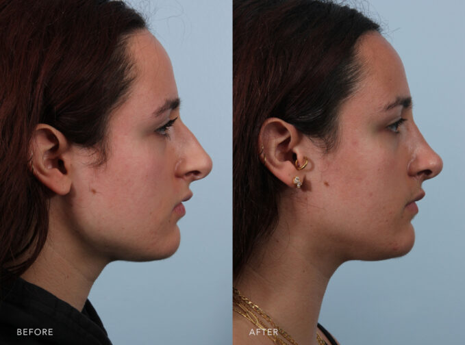 A side-by-side view of a woman's face before and after the Rhinoplasty procedure. Before photo shows a crooked or bent nose, lacking a straight and symmetrical alignment, especially when viewed from the front or the side. The after photo shows a straight and centered nasal septum, ensuring that both nostrils are equal in size and shape. There is no deviation or off-center alignment. | Albany, Latham, Saratoga NY, Plastic Surgery 