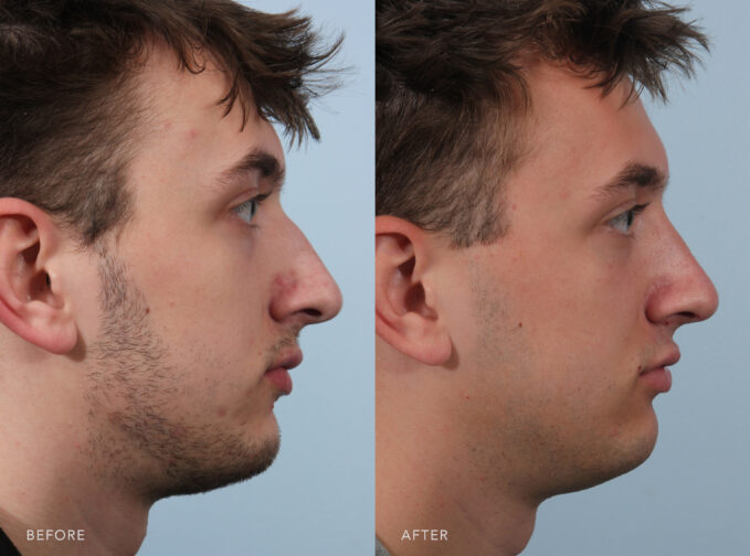 A side-by-side view of a man's face before and after the Rhinoplasty procedure. Before photo shows larger or more flared nostrils than desired, affecting the overall harmony of the nose with the rest of his facial features. The after photo shows smaller and more proportionate nostrils to the rest of his nose, creating a more cohesive and natural look. | Albany, Latham, Saratoga NY, Plastic Surgery