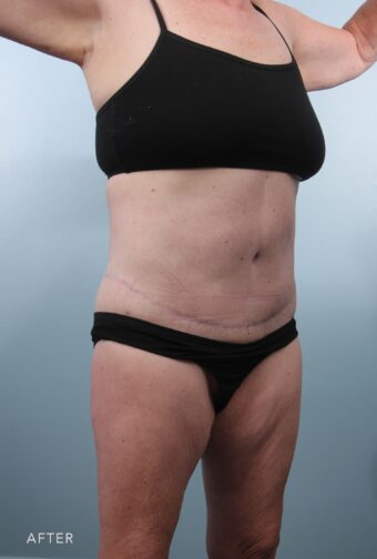 A photo of a woman's body shows tightened skin and a reduced appearance of wrinkles and sagging in her inner and outer thighs, with fewer folds and a smoother surface. | Albany, Latham, Saratoga NY, Plastic Surgery