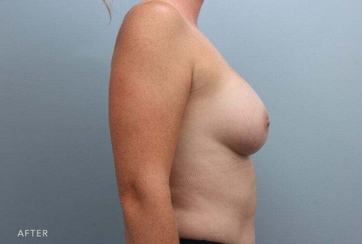 A photo of a woman's body shows a more rounded and shapely appearance, enhancing the overall profile of her body and making her chest appear more prominent and defined. | Albany, Latham, Saratoga NY, Plastic Surgery