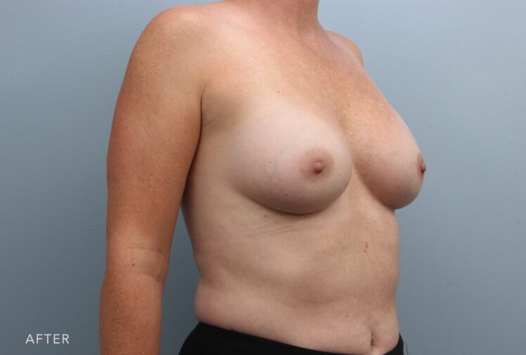 A photo of a woman's body shows tighter and smoother skin due to the added volume beneath it, giving her breasts a more youthful texture and appearance. | Albany, Latham, Saratoga NY, Plastic Surgery