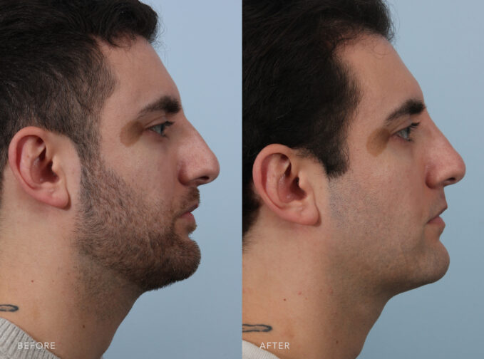 A side-by-side view of a man's face before and after a Cosmetic Rhinoplasty procedure. Before photo shows an over-projected nasal length, causing it to dominate his facial features and create an unbalanced appearance. The after photo shows a smoother contour and fewer visible irregularities or harsh angles, with a seamless and soft nasal bridge. | Albany, Latham, Saratoga NY, Plastic Surgery