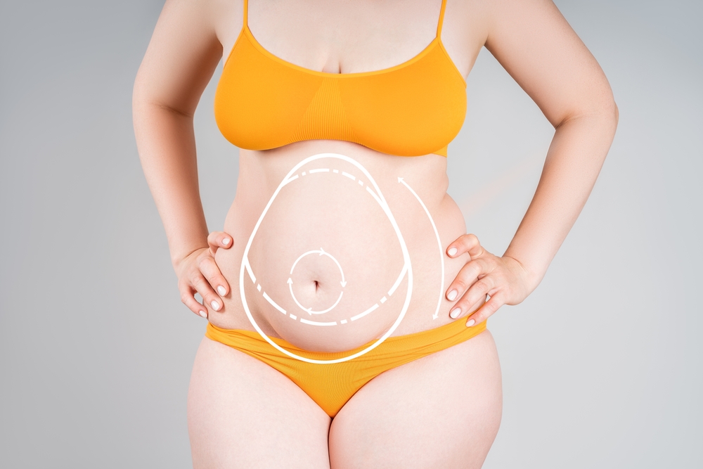 Best Tummy Tuck Surgery Cost in Albany