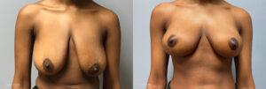 Does Insurance Cover Breast Reduction