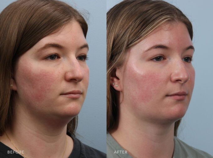 A side-by-side view of a woman's face before and after the Neck Liposuction procedure. Before photo shows a smooth contour between her chin and neck with a little distinction between the two areas, giving the appearance of a fuller or thicker neck. The after photo shows a slimmer neck with the removal of excess fat, reducing previous fullness or bulkiness, especially under her chin and along the sides of her neck. | Albany, Latham, Saratoga NY, Plastic Surgery