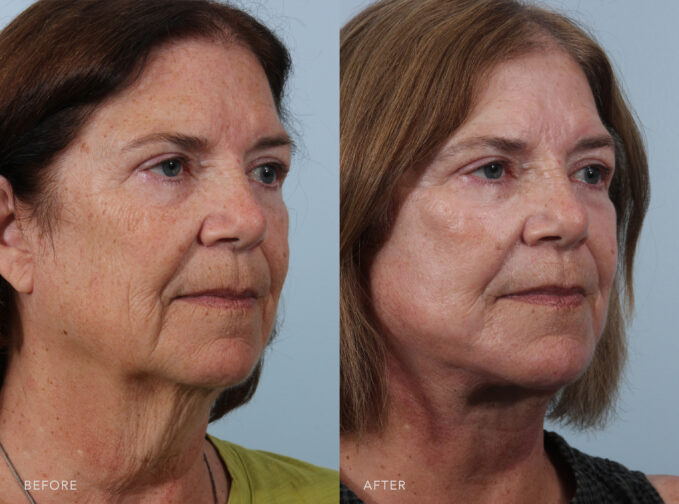 A side-by-side view of a woman's face before and after the Deep Plane Facelift and Chemical Peel procedure. Before photo shows fine lines and deeper wrinkles, especially around her forehead, eyes, and chin, due to her skin losing elasticity and collagen over time. The after photo shows much smoother, with a reduction in the rough, dry patches that were visible before, creating a more youthful appearance. | Albany, Latham, Saratoga NY, Plastic Surgery