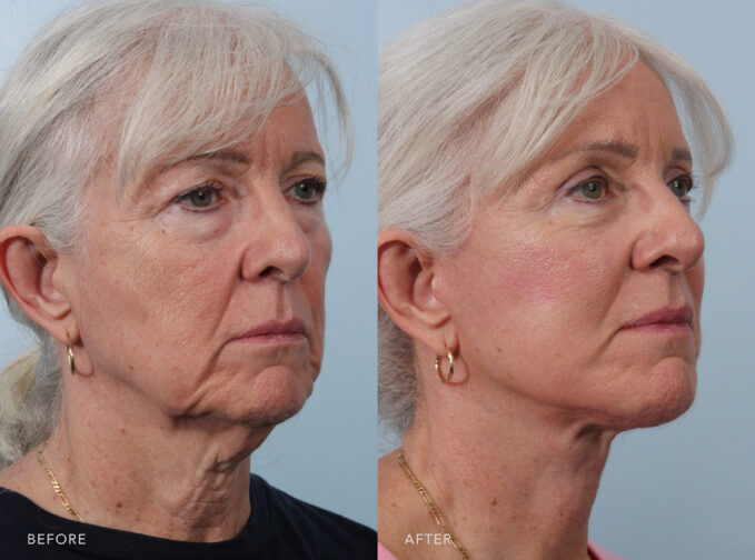 A side-by-side view of a woman's face before and after Deep Plane Lower Face and Neck Lift procedure. Before photo shows a less distinct jawline as the jowls develop, leading to a less defined facial profile and a tired or less youthful appearance. While the after photo shows a smooth and uniform curve of her jawline without any visible indentions or irregularities, complementing the overall facial feature. | Albany, Latham, Saratoga NY, Plastic Surgery