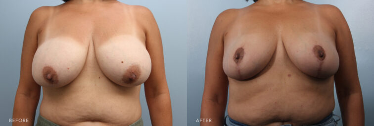 A photo of a woman's body before and after the Bilateral Breast Reduction. Before photo shows large breasts, with a substantial amount of breast tissue contributing to a full and heavy appearance. The after photo shows non-sagging breasts, where the nipple position is centered or slightly upward-facing, sitting above or around her breast crease. | Albany, Latham, Saratoga NY, Plastic Surgery