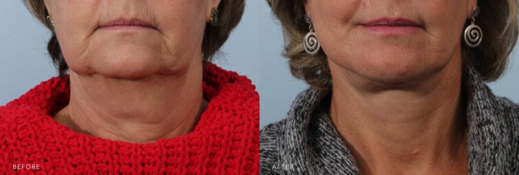 A photo of a woman's lower face before and after the Deep Plane Facelift procedure. Before photo shows jowls that blur the natural contour of her jawline, contributing to a heavier and squared appearance. The after photo shows a rejuvenated lower face, mid-face, and neck, restoring her facial balance with diminished fine lines and wrinkles. | Albany, Latham, Saratoga NY, Plastic Surgery