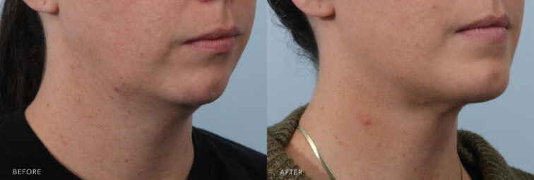 A side-by-side view of a woman's lower face before and after the Neck Liposuction procedure. Before photo shows accumulated fat around her jawline and neck, obscuring the natural contours, creating a softer, less structured appearance, and diminishing the sharpness and tone associated with a well-defined profile. The after photo shows a precise fat reduction and detailed contouring. Her neck achieves smooth, harmonious lines that enhance its aesthetic appeal, resulting in a longer, leaner, and more gracefully defined look. | Albany, Latham, Saratoga NY, Plastic Surgery