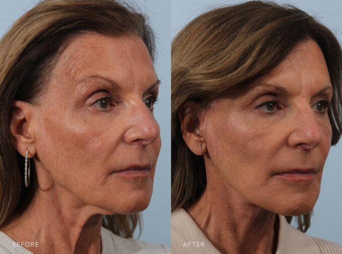 A side-by-side view of a woman's face before and after the Facelift procedure. Before photo shows loose or drooping skin around her jawline and cheeks due to a loss of skin elasticity and collagen. The after photo shows a smoother and more lifted look, particularly around her cheeks, jawline, and neck. | Albany, Latham, Saratoga NY, Plastic Surgery