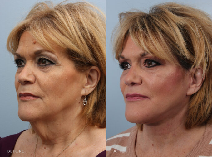 A side-by-side view of a woman's face before and after the Deep Plane Lower Face and Neck Lift procedure. Before photo shows a shortened neck appearance due to the extra volume under her chin, her neck appears shorter and less elongated, impacting her overall facial profile. The after photo shows a longer, elongated neck appearance with the removal of excess fat. Her neck appears longer and more elegant, enhancing the overall balance and harmony of her face. | Albany, Latham, Saratoga NY, Plastic