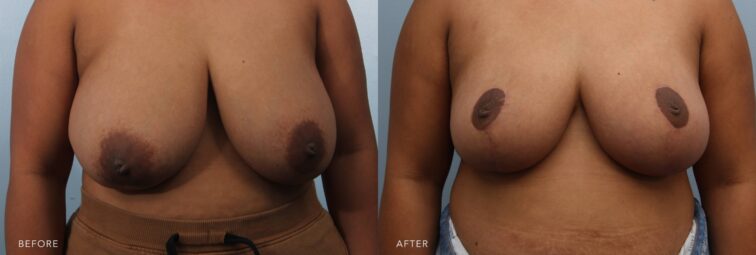 A photo of a woman's body before and after the Bilateral Breast Reduction procedure. Before photo shows disproportionately large breasts compared to the rest of the body, drawing unwanted attention or causing self-consciousness. The after photo shows smaller and more proportionate breasts to her body frame, improving overall aesthetics and balance. | Albany, Latham, Saratoga NY, Plastic Surgery  