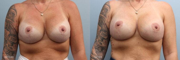 A photo of a woman's body before and after the Breast Revision procedure. Before photo shows unnatural firmness or misshapen breasts due to the tightening of scar tissue around her implants, looking distorted or overly round, especially in the upper pole. The after photo shows her implants positioned properly within her chest, eliminating malposition issues like bottoming out and lateral displacement. | Albany, Latham, Saratoga NY, Plastic Surgery