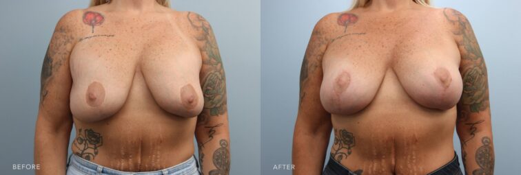 A photo of a woman's body before and after the Lift with Augmentation procedure. Before photo shows flat and stretched breasts, looking wider at the base due to sagging, which causes them to spread outward rather than projecting forward, the after photo shows removed excess breast skin and the remaining skin pulled taut to support the new breast shape. | Albany, Latham, Saratoga NY, Plastic Surgery