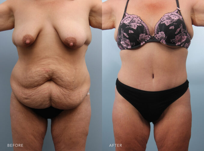 A photo of a woman's body before and after the Panniculectomy w/ Tummy Tuck and Liposuction procedure. Before photo shows loose or sagging skin on her abdomen, contributing to the wrinkled appearance. The after photo shows a smooth and flat contour without noticeable bulges or protrusions, extending from the upper abdomen to her lower abdomen. | Albany, Latham, Saratoga NY, Plastic Surgery