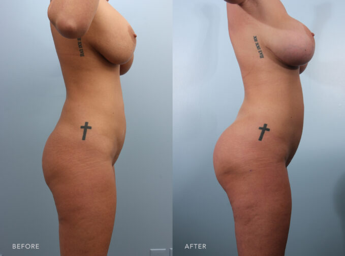 A side-by-side view of a woman's body before and after the Brazilian Butt Lift procedure. Before photo shows a flat or less prominent buttocks shape, lacking fullness or roundness. The natural curve between her lower back and the buttocks is not well defined. The after photo shows noticeably fuller and rounder, with enhanced volume and a more prominent and contoured shape. The natural curves between her lower back, hips, and buttocks are more defined. | Albany, Latham, Saratoga NY, Plastic Surgery