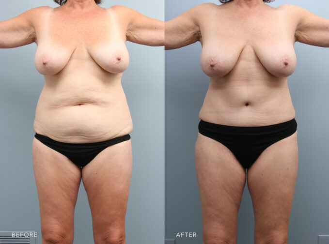 A photo of a woman's body before and after the Tummy Tuck with Liposuction procedure. Before photo shows loose or sagging skin in her abdomen due to aging or significant weight fluctuations, creating folds or hanging over her waistband. The after photo shows a flatter and more toned abdomen with her removed excess skin, resulting in a smoother and firmer contour. | Albany, Latham, Saratoga NY, Plastic Surgery