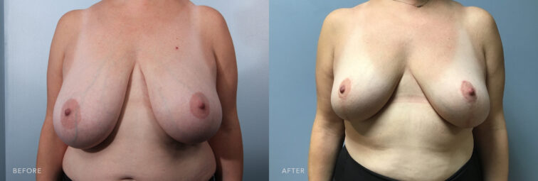 A photo of a woman's body before and after the Bilateral Breast reduction procedure. Before photo shows loss of skin elasticity and weakening of connective tissues due to natural aging, causing her breasts to sag. The after photo shows removed excess skin and tightened surrounding tissue, raising her breasts and giving them a firmer appearance. | Albany, Latham, Saratoga NY, Plastic Surgery