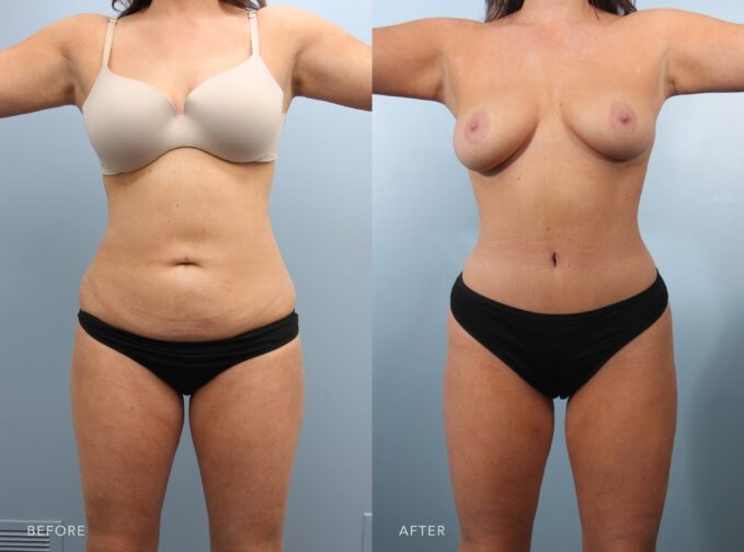 A photo of a woman's body before and after the Abdominoplasty procedure. Before photo shows stubborn fat pockets in the lower belly, upper abdomen, and along the sides, contributing to an uneven or bulky appearance. The after photo shows rejuvenated abdominal skin, with a firmer texture and improved elasticity. | Albany, Latham, Saratoga NY, Plastic Surgery