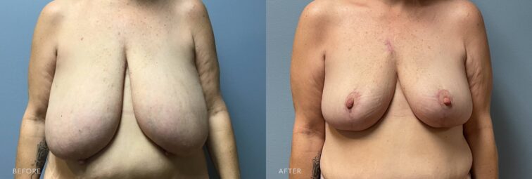 A photo of a woman's body before and after the Bilateral Breast Reduction procedure. Before photo shows dense and heavy breasts with significant bulk concentrated in the lower poles. The after photo shows a breast that is significantly smaller and lighter with excess tissue removed, creating a more proportional size relative to her body. | Albany, Latham, Saratoga NY, Plastic Surgery