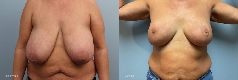 A photo of a woman's body before and after the Bilateral Breast Reduction procedure. Before photo shows sagging, heavy, and elongated breasts due to the weight of excess breast tissue and skin. The after photo shows smaller breasts, with the excess tissue and fat removed, achieving a size that is more comfortable and proportionate to her body frame. | Albany, Latham, Saratoga NY, Plastic Surgery