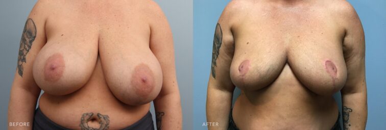 A photo of a woman's body before and after the Bilateral Breast Reduction procedure. Before photo shows the uneven shape and size of her breasts. One breast appears larger, smaller, or more saggy than the other, creating noticeable asymmetry in both size and contour. The after photo shows a well-rounded and firm breast, with balanced fullness in both the upper and lower poles. | Albany, Latham, Saratoga NY, Plastic Surgery