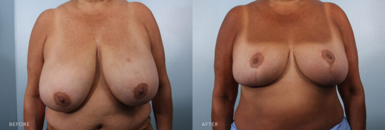 A photo of a woman's body before and after the Bilateral Breast Reduction procedure. Before photo shows an elongated shape of her breasts, with the fullness concentrated in the lower portion. The upper portion appears deflated or flat, contributing to the sagging look. The after photo shows normal-sized breasts and is proportional to her overall body frame. They appear balanced with the torso and do not seem overly large or small for her height and weight. | Albany, Latham, Saratoga NY, Plastic Surgery