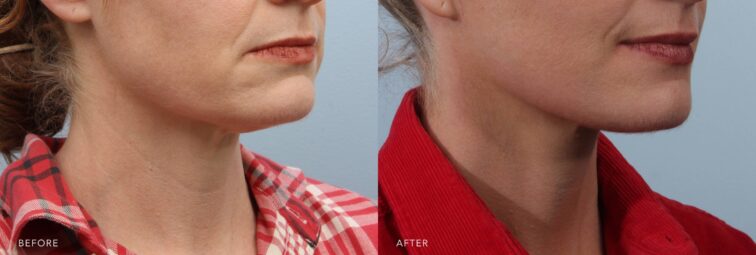 A side-by-side view of a woman's face before and after the Deep Plane Facelift procedure. Before photo shows cheeks that merged with her lower face due to the lack of clear distinction. The after photo shows a youthful facial contour and an inverted triangle shape, with more volume in her upper face than the lower. | Albany, Latham, Saratoga NY, Plastic Surgery