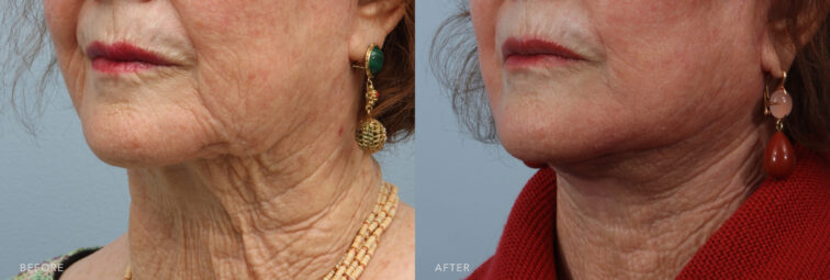 A side-by-side view of a woman's lower face before and after the Deep Plane Lower Face and Neck Lift procedure. Before photo shows a less defined neck, with sagging and wrinkles blurring the natural lines between the jaw and neck, contributing to an overall older