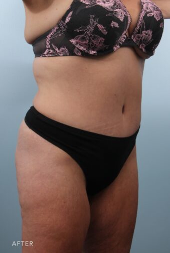 A photo of a woman's body shows less subcutaneous fat, resulting in a leaner appearance and contributing to the flatness of her abdominal area. | Albany, Latham, Saratoga NY, Plastic Surgery